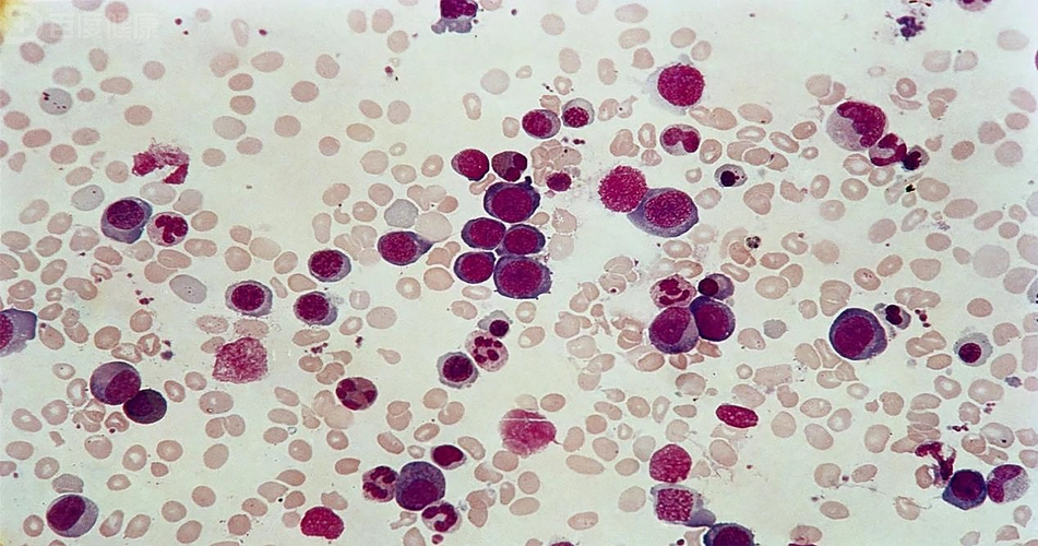 贫血合并呕吐食欲减退警惕巨幼红细胞贫血