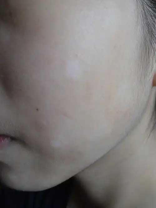 睾丸上长白色糠疹图片