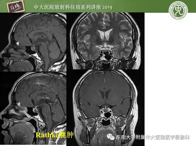 垂体正常及常见疾病影像表现
