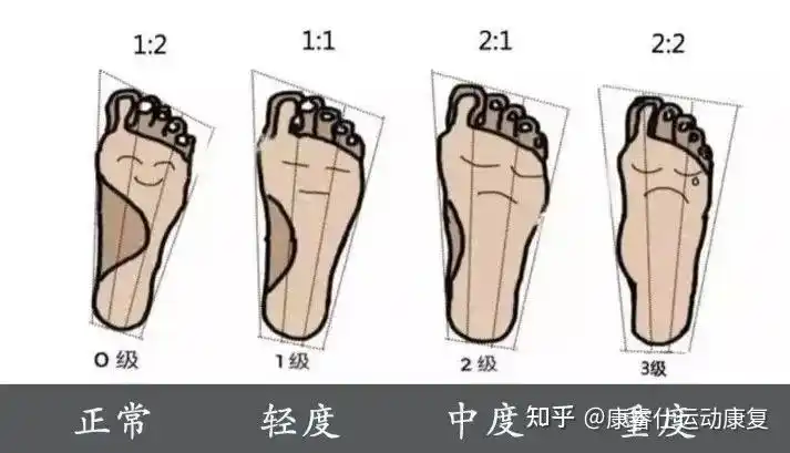 两步教你判断是否扁平足