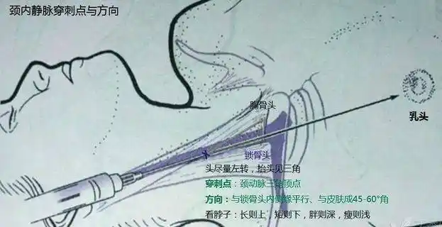 手把手教你颈内静脉穿刺术!(收藏版)