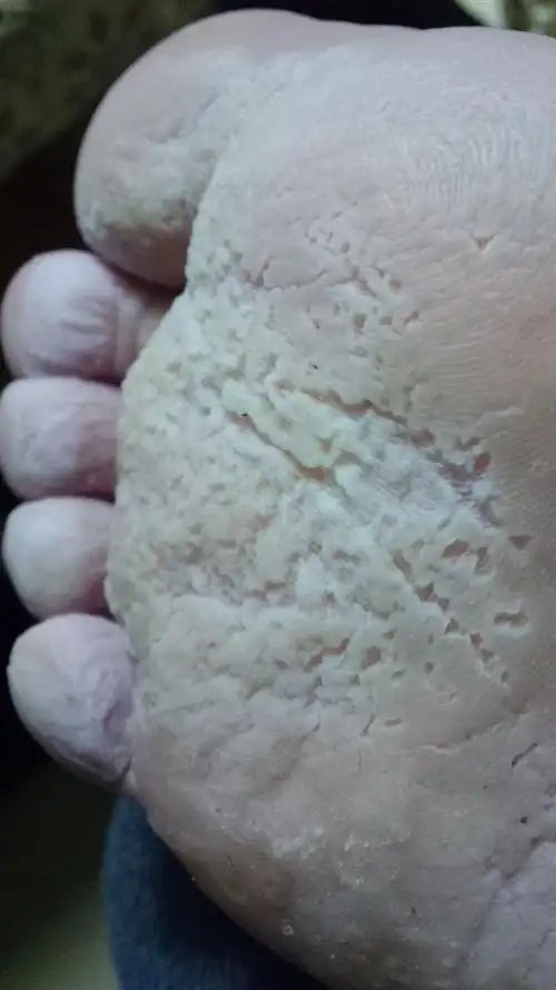 脚底有很多小洞洞