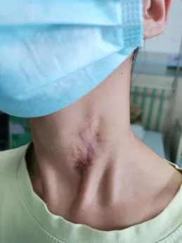 儿童颈部反复感染化脓带你了解先天性梨状窝瘘