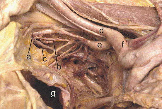 a,闭孔神经; b, 闭孔动脉; c, 闭孔静脉; d, 髂外动脉; e, 髂内