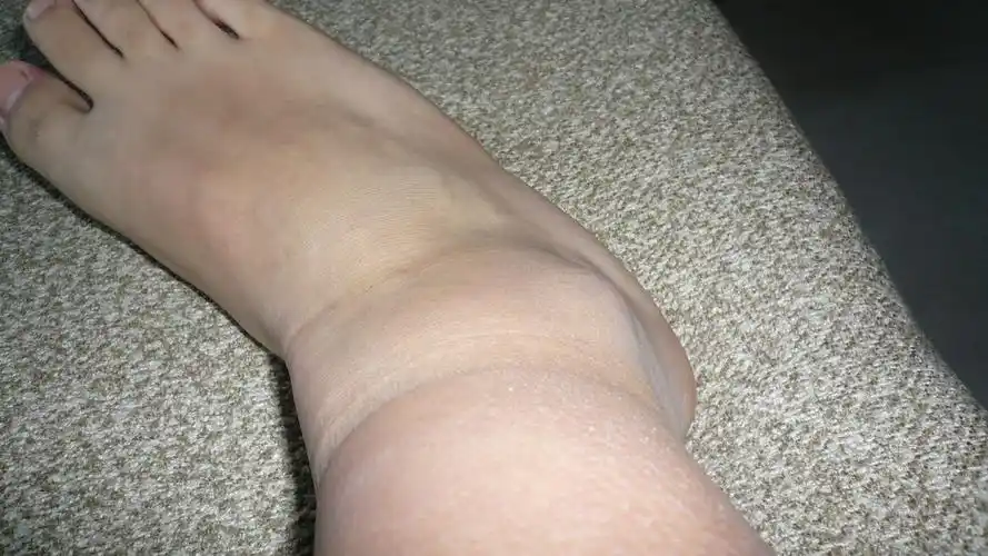 看看这是腱鞘炎吗