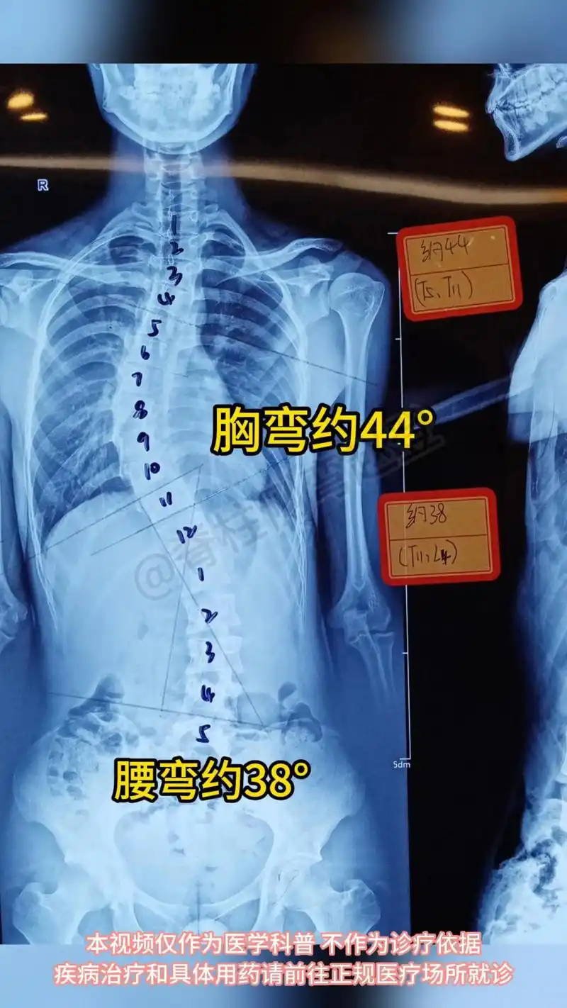为什么我们总强调脊柱侧弯要早发现早干预呢?