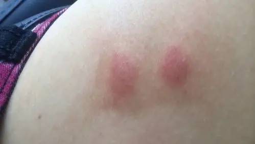 臭虫咬的症状图片50