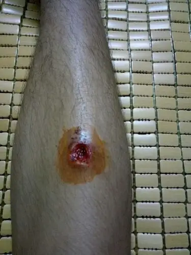 腿上被磕伤,掉了块肉,现在两个星期过了没好而且有个洞了,该怎么治