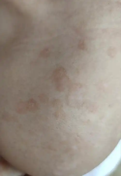 粘人的"汗斑"甩不掉_花斑癣_花斑癣发病原因 - 好大夫在线