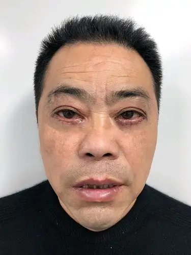 说什么的都有,心里有点虚啊,万一失败了,出现眼睑外翻或是眼角下垂