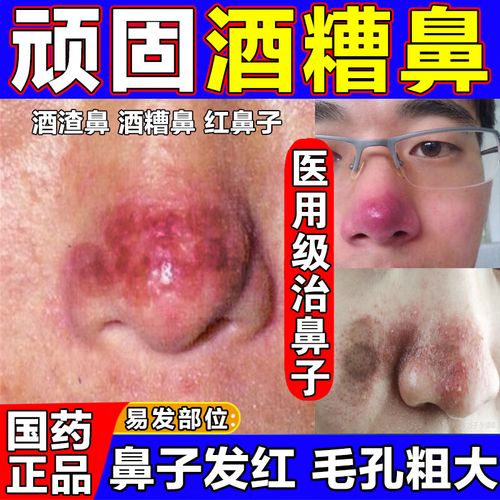 酒糟鼻专用药膏治酒渣鼻红鼻子草莓鼻药膏 修复鼻子红血丝粉刺去黑头