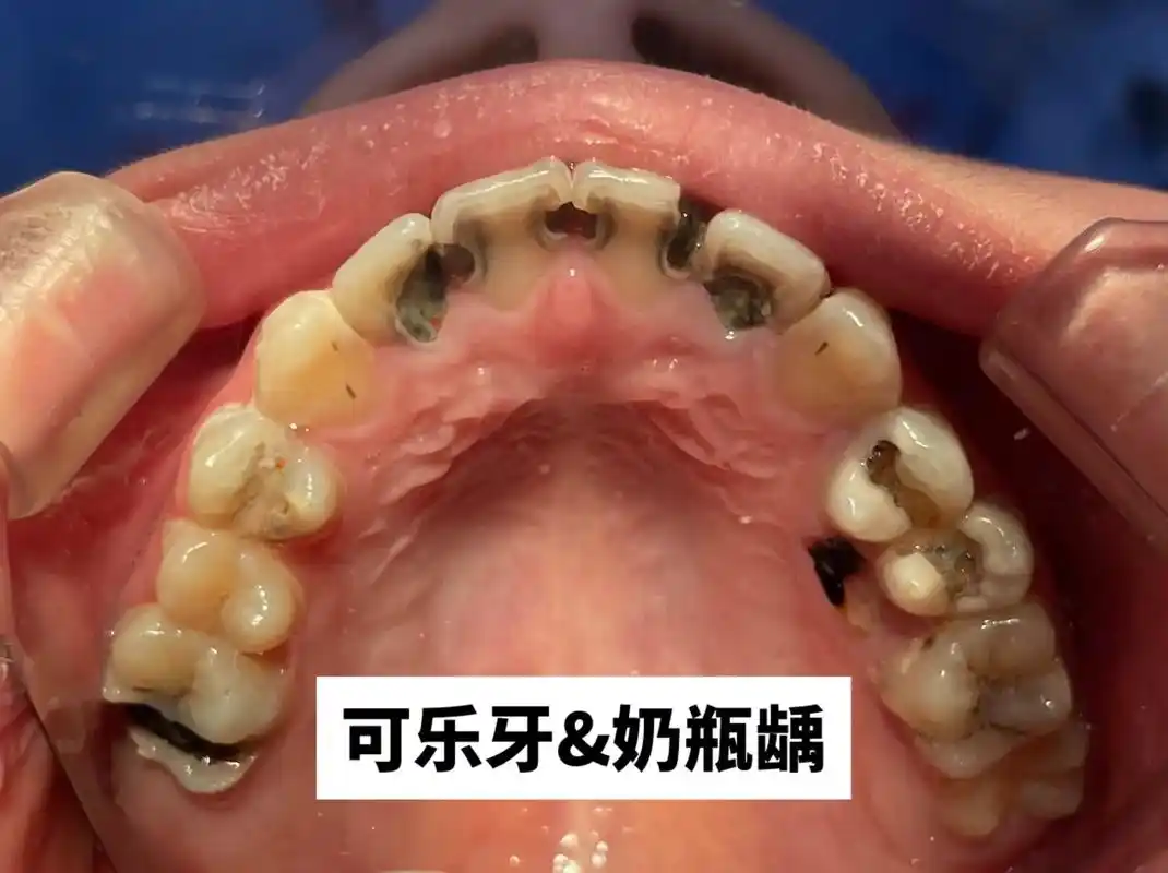 卧龙凤雏:弟弟看牙痛的时候健康教育半天,我还能淡定的沟通,直 - 抖音