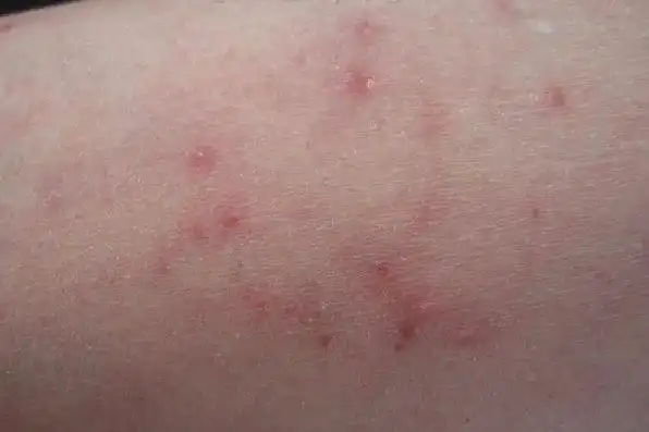 1,细菌性毛囊炎细菌感染是感染性毛囊炎最常见的病因,早期临床表现为