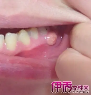牙龈肿痛都是由什么引起的?人怎么办?-爱慕生活网