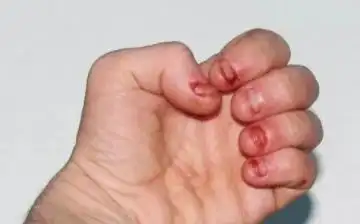 啃指甲的严重后果小孩啃指甲的危害图片