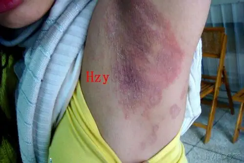 左腋下发痒疼痛三个月