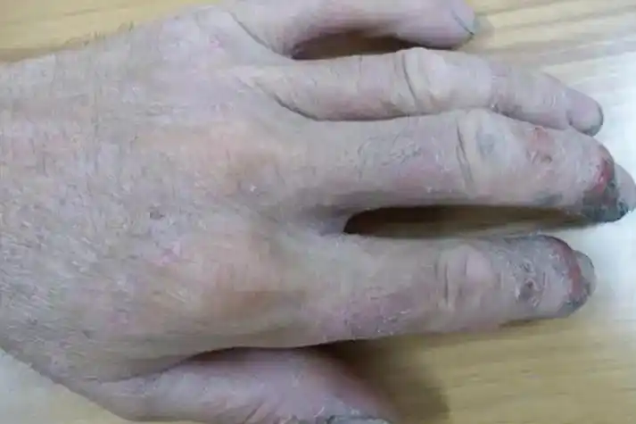 水泥过敏皮肤糜烂图