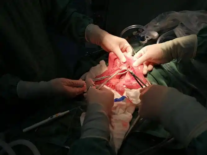 03.04腹腔镜下全胃切除 胆囊切除术