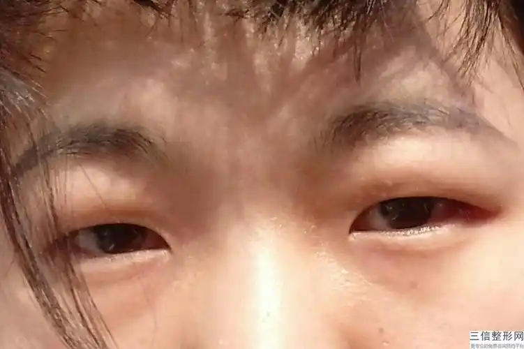 做双眼皮影响做近视眼手术吗(眼睛近视做双眼皮有影响吗)