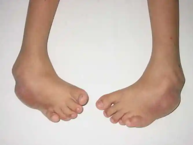 马蹄内翻足的诊断