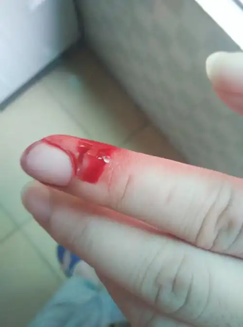 手上被划了一刀,然后有一大半肉掉了,我又把它按回去消毒,然后长了