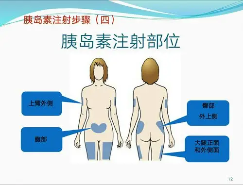 让我们来告诉您胰岛素注射的正确部位!