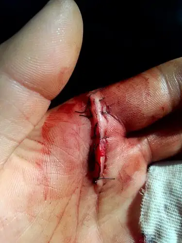 手掌缝针褶皱大影响以后手指伸直吗?