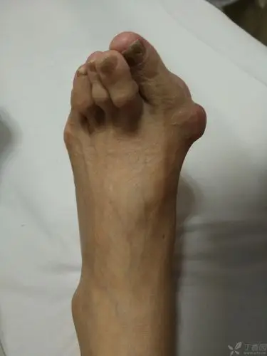一例类风湿关节炎导致的拇外翻畸形 [病例帖]