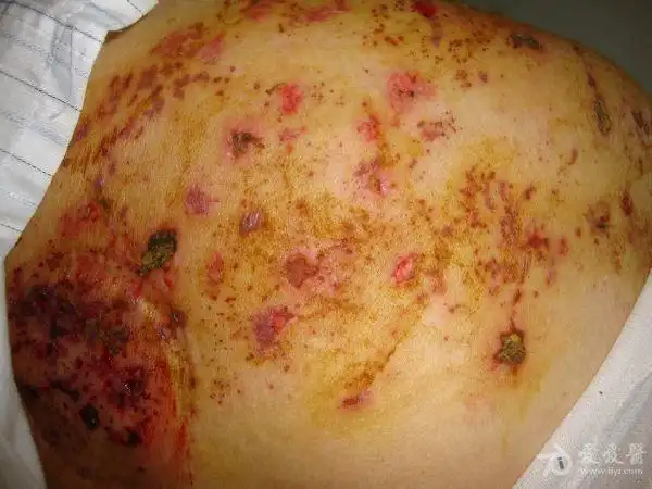 80岁带状疱疹的心声