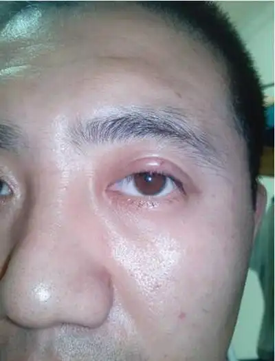 轻微沙眼的症状图片55