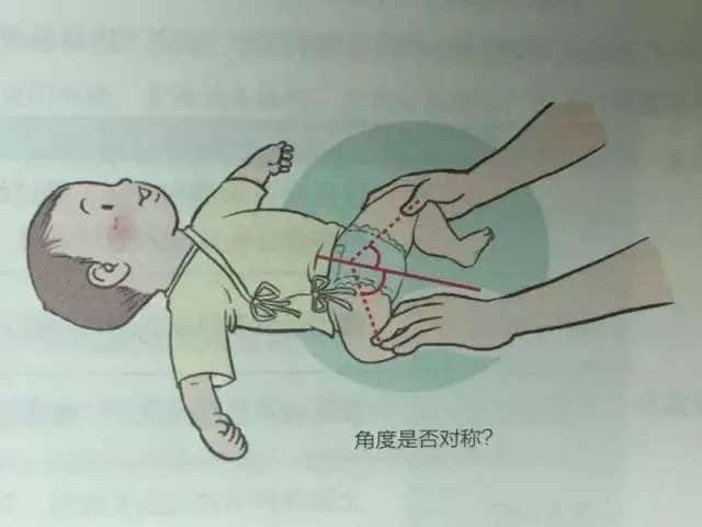 孩子是否存在有髋关节发育不良,还是要由专业医生检查后来判断.