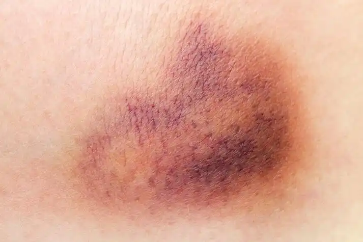 肚皮上出现淤青图片