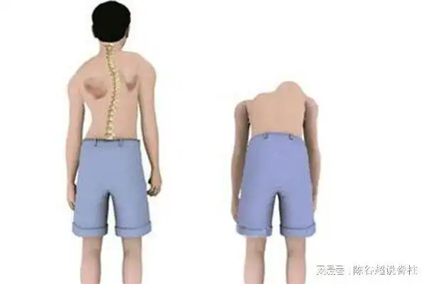 得了脊柱侧弯无法治疗?及时主动接受治疗,能恢复正常生活