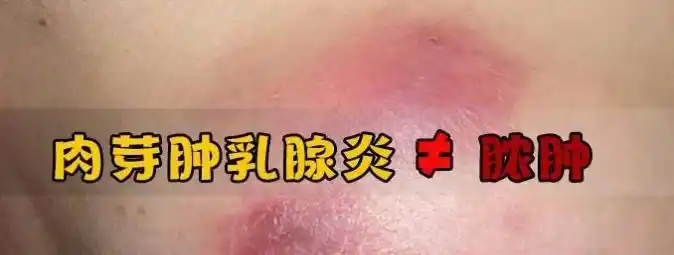 肉芽肿乳腺炎glm不是脓肿