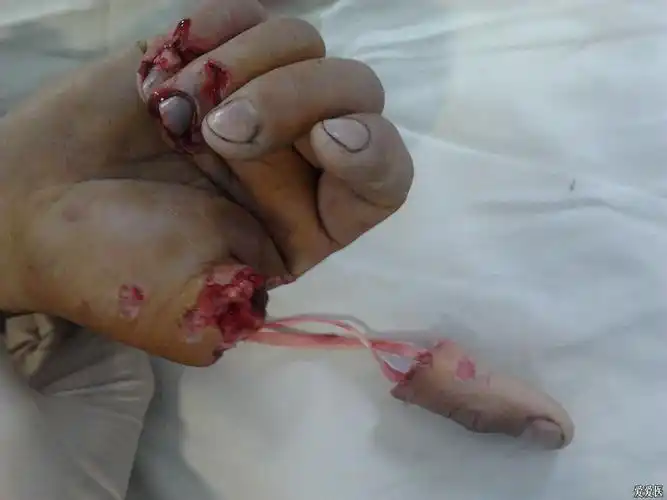 屈,伸肌腱分别从环