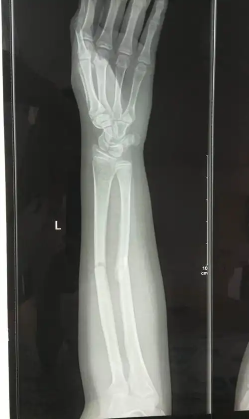 创伤骨一科完成两例弹性髓内针治疗小儿长骨骨折手术,小儿骨科治疗