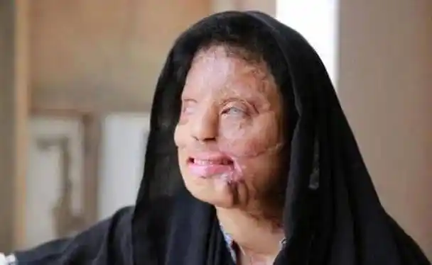 人的皮肤和黏膜也不例外,因此,当浓硫酸被泼到人脸上时,首先会对面部