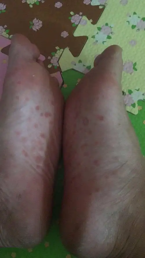 请问这张照片是梅毒二期疹么