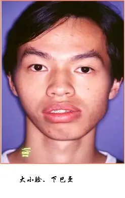 日常生活中常常见到一些牙颌面畸形患者,比方说"暴牙齿"——上颌前突