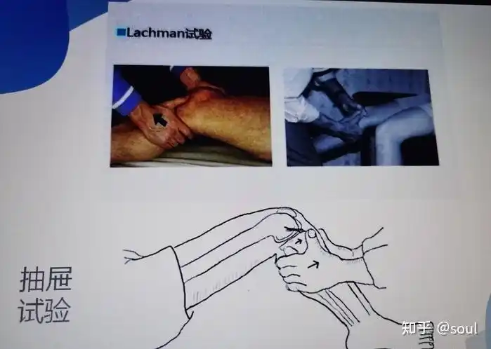 对于内外侧副韧带的损伤,可以通过侧方应力试验来进行检查,对于前后