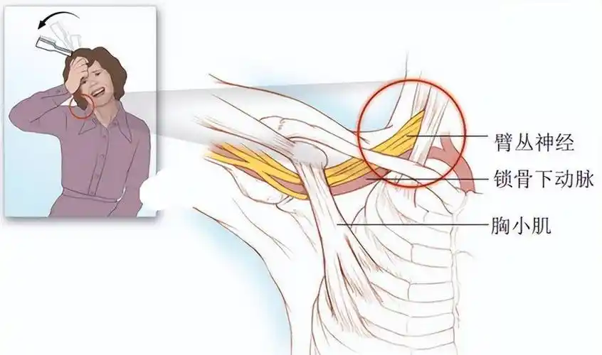 上肢肿胀,充血要检查身材廓出口_锁骨_患者_综合征