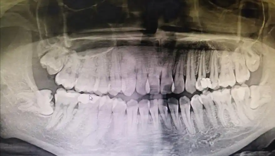 根尖炎(牙髓炎)