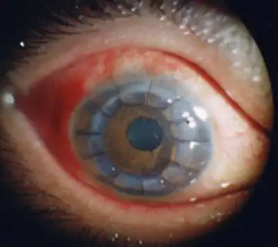 青光眼前期症状轻微,患者可有轻度眼痛,视力下降,虹视并伴有轻度同侧