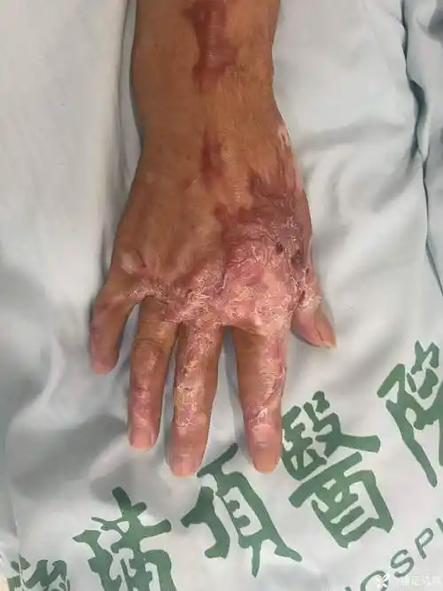 丁香园论坛>修复重建和烧伤整形>帖子详情>