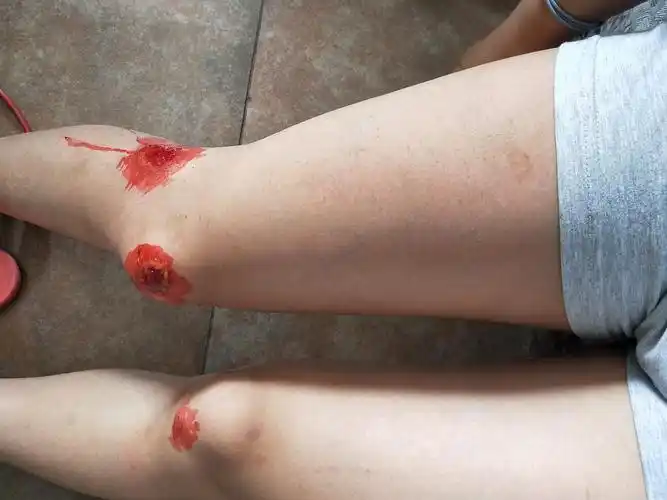 骑车摔了特别惨图片慎入