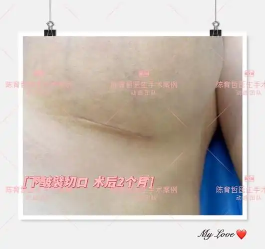 诊间日记:假体隆胸下皱襞切口,疤痕明显吗?