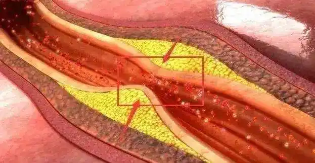 冠状动脉斑块_动脉粥样硬化_介绍_检查 - 好大夫在线