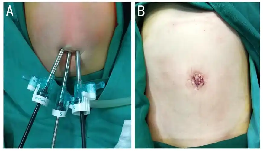 经脐单切口腹腔镜手术治疗小儿食管裂孔疝_食管裂孔疝_疾病介绍_手术