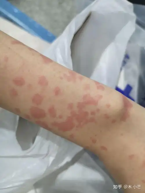 药物过敏引起的荨麻疹治疗