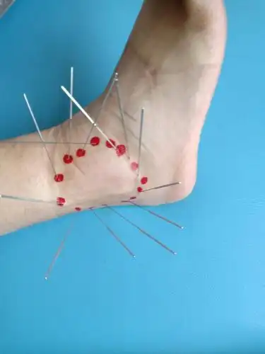 妙用内热针让您不再疼